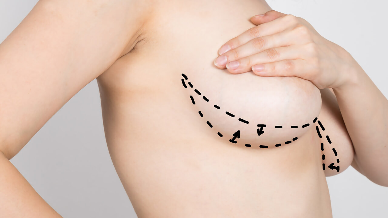 как уменьшить объем груди у женщин фото 83